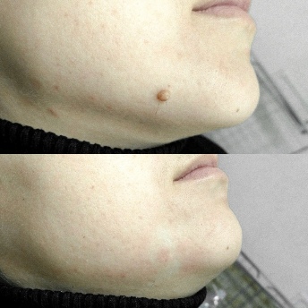 Before and after using Skincell Pro