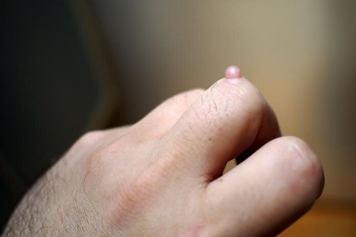warts on the finger