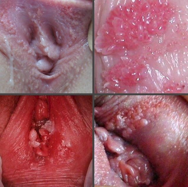 Enlargement of papillomas in the vagina