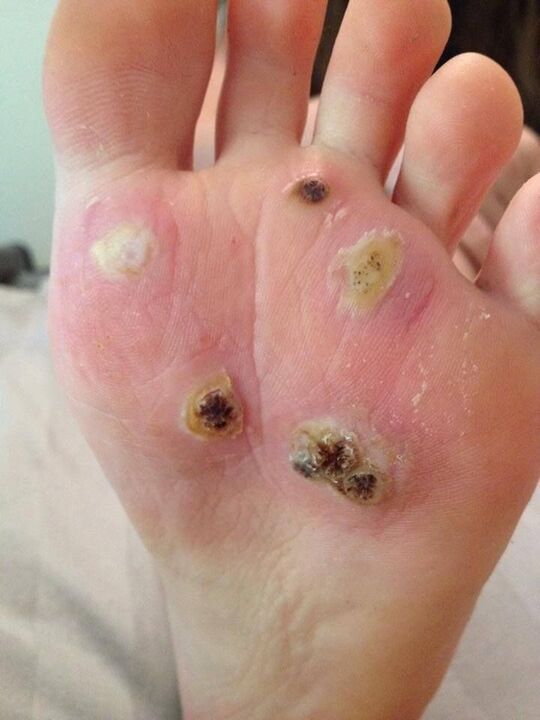 warts on the legs