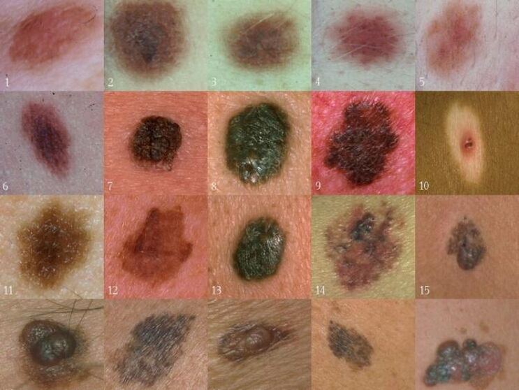 Types of skin warts