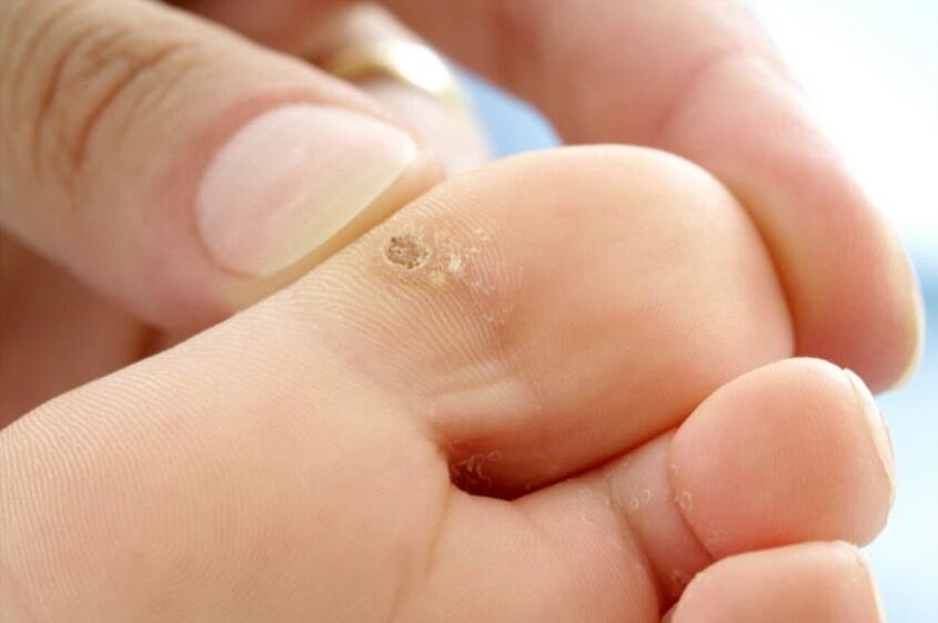 Warts on the toes