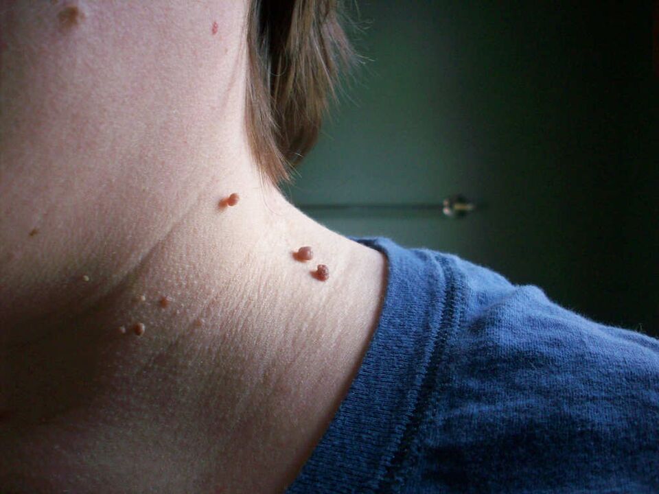 How to treat papilloma on the neck