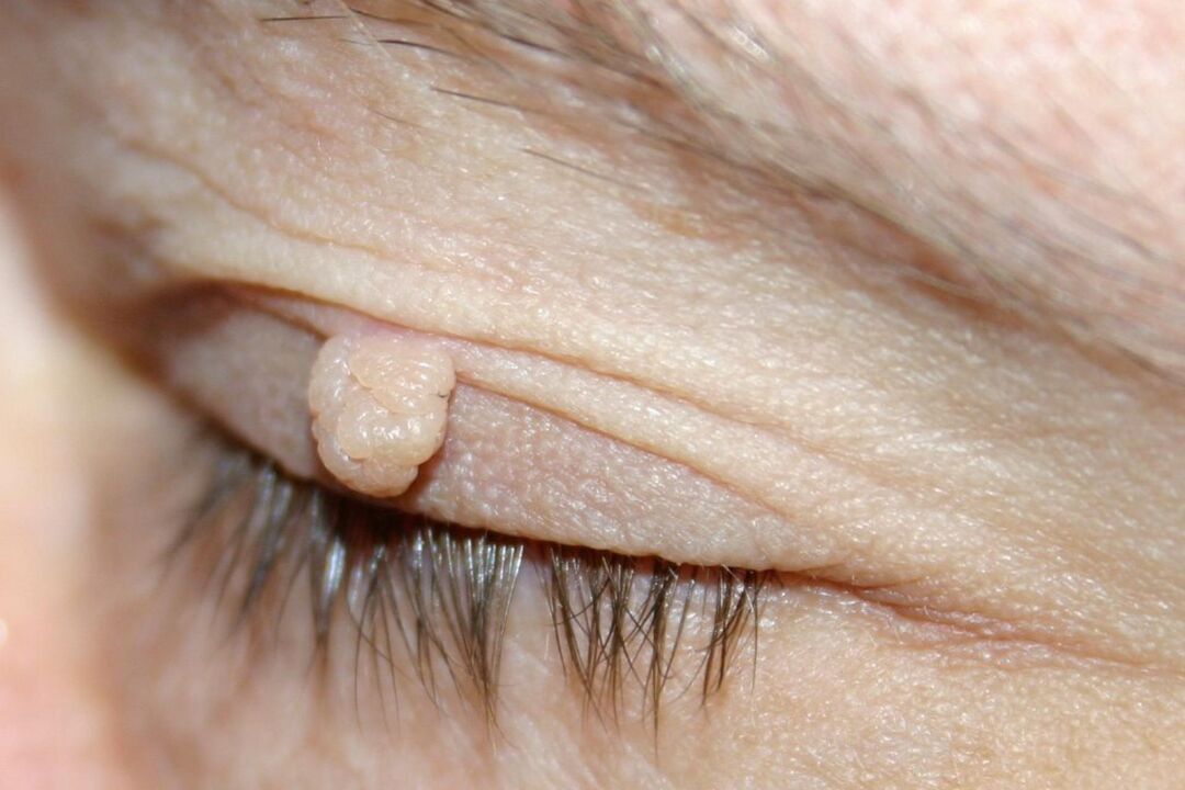 Papilloma symptoms of the eyelid