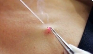 laser removal of papillomas in the body
