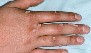 types of warts and methods of their elimination